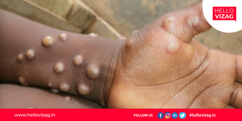 Centre's guidelines for monkeypox patients
