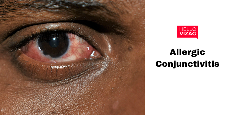 Protect your eye before it is infected with conjunctivitis